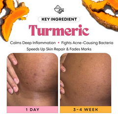 Glow Pads for Butt Acne & Dark Spots