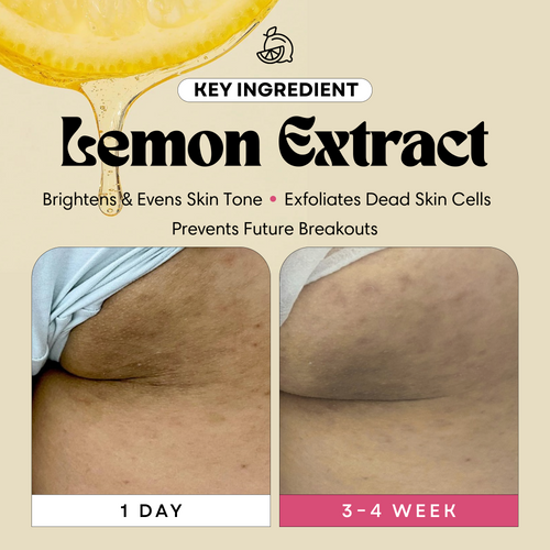 Glow Pads for Butt Acne & Dark Spots